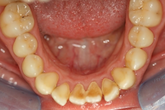 Treatments And Prevention Of Dental Calculus